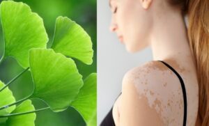 plantas medicinales para vitiligo